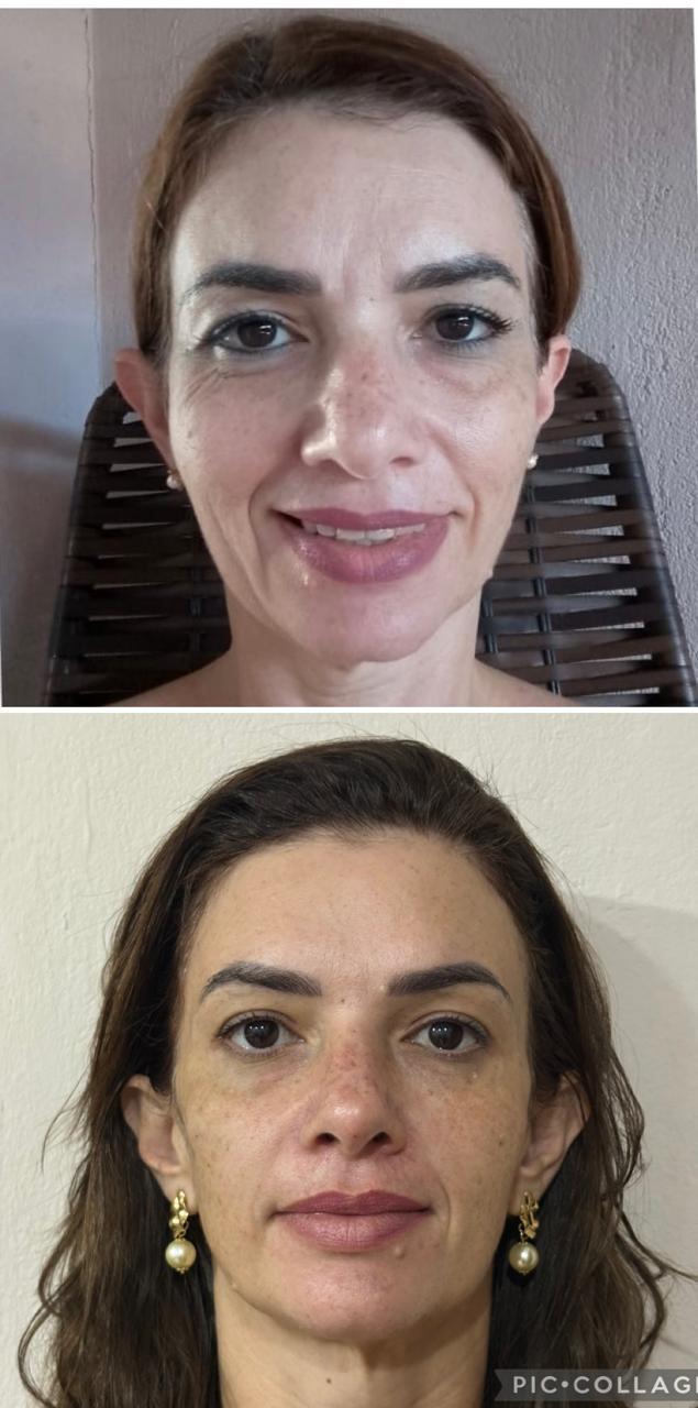 Resultado de harmonização facial na clínica Nayara Martins