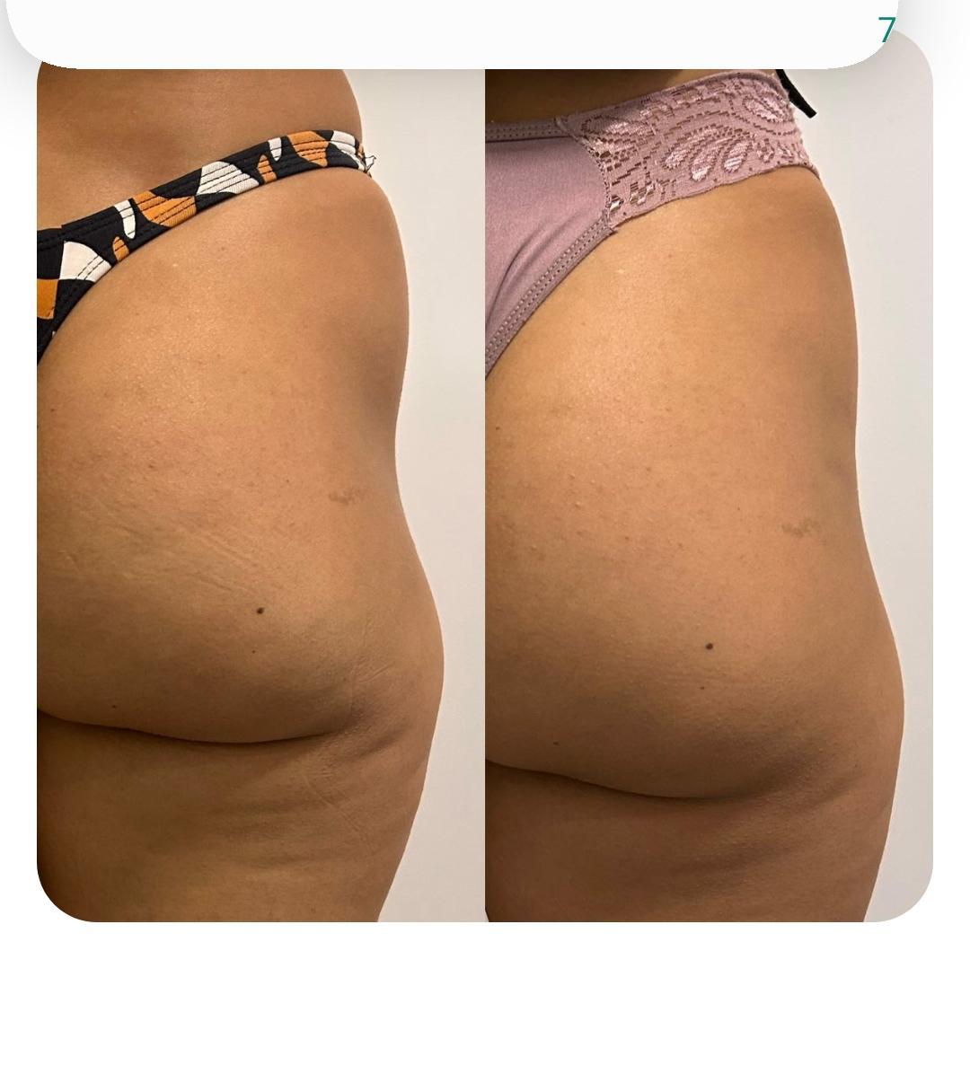 Antes e depois — harmonização glútea