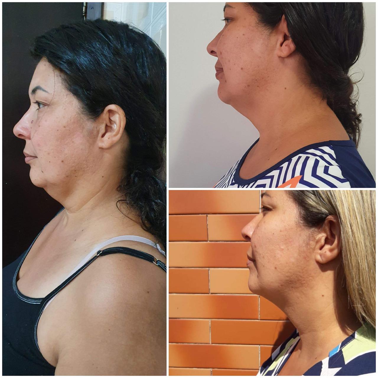 Antes e depois — lipo de papada