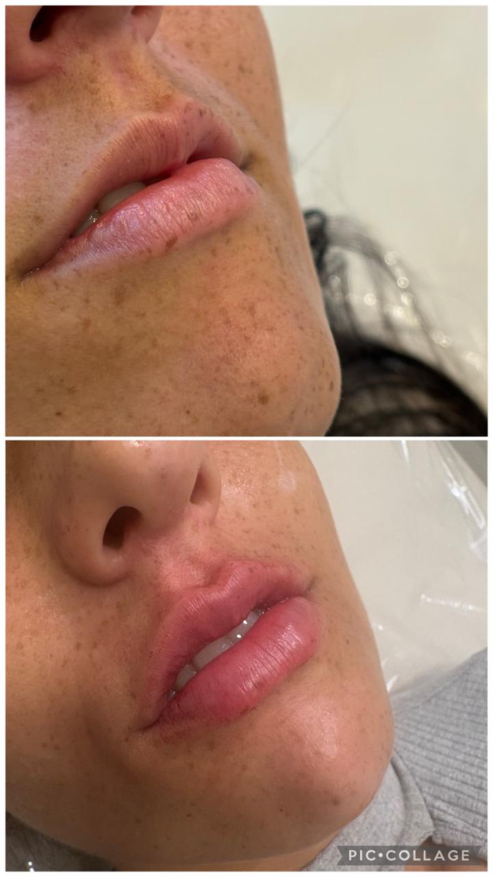 Antes e depois — preenchimento labial