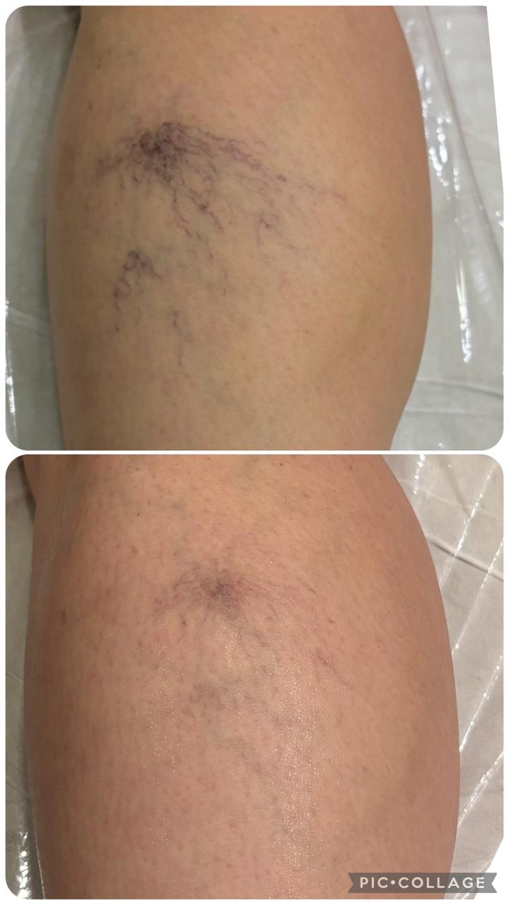 Antes e depois — PEIM secagem de vasinhos