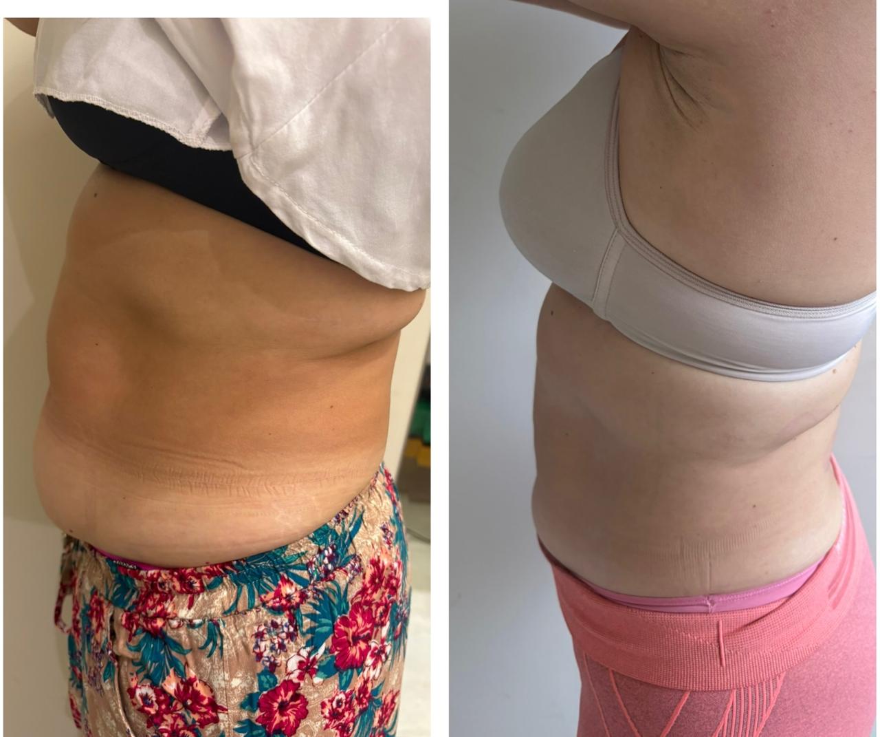 Antes e depois — tratamento para gordura localizada