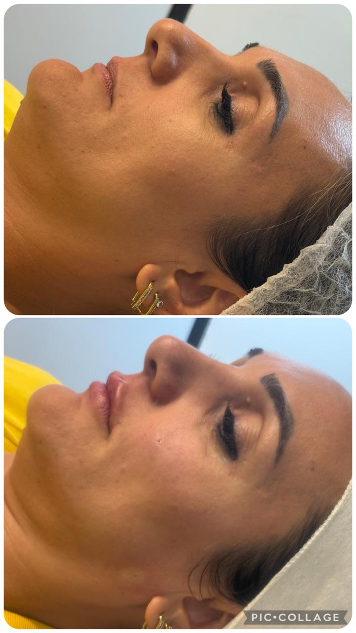 Antes e depois — rinomodelação e preenchimento labial