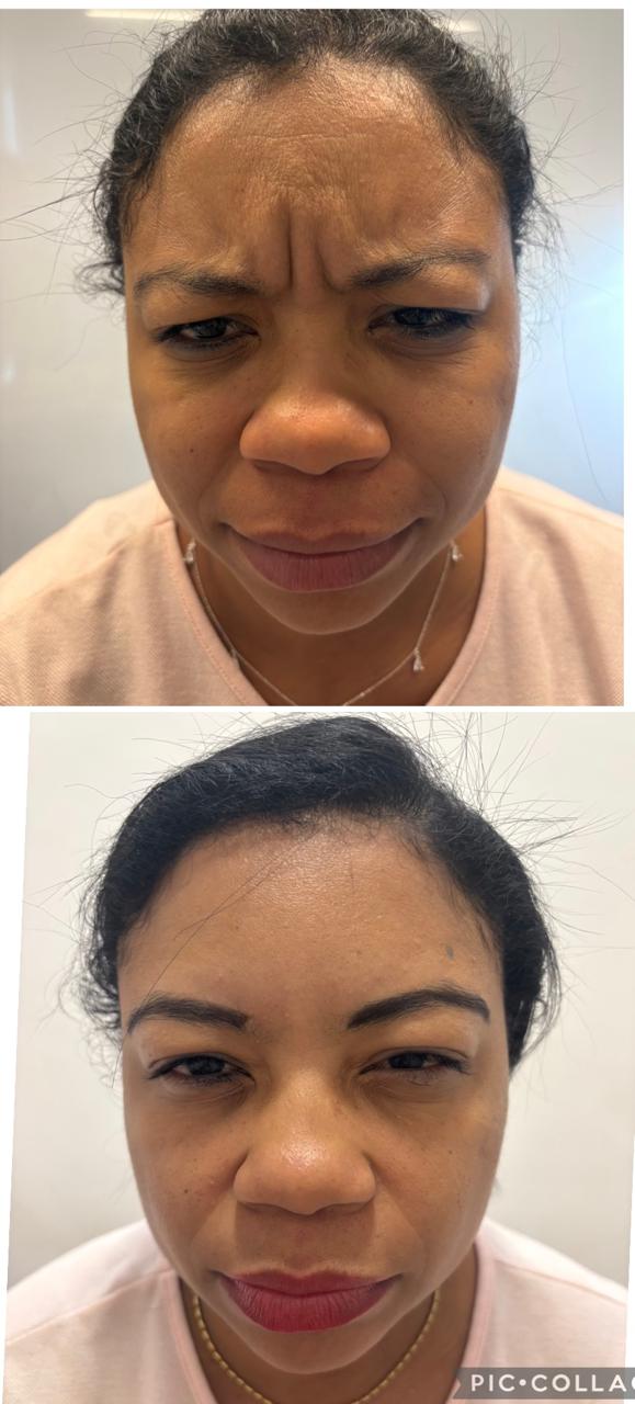 Antes e depois — toxina botulínica, glabela