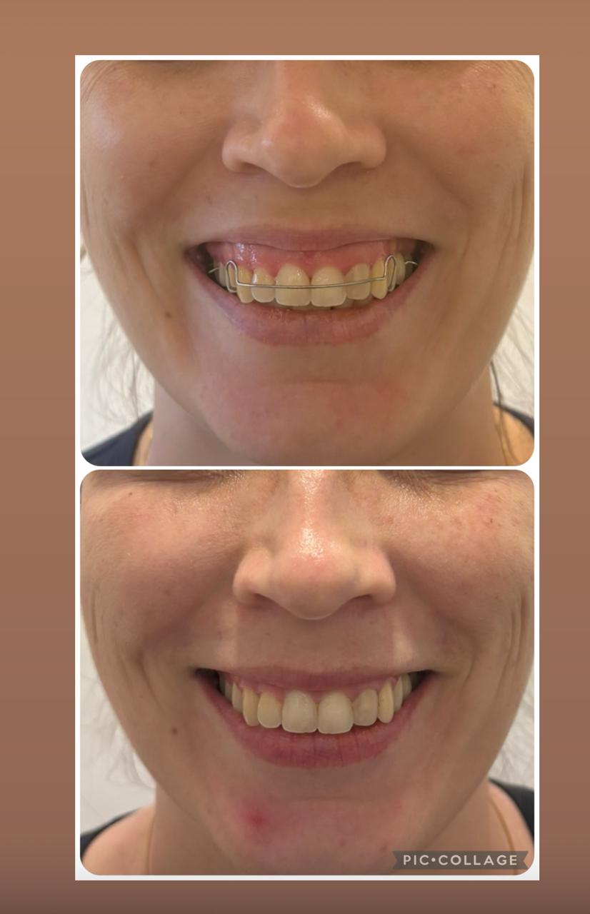 Antes e depois — toxina botulínica para sorriso gengival