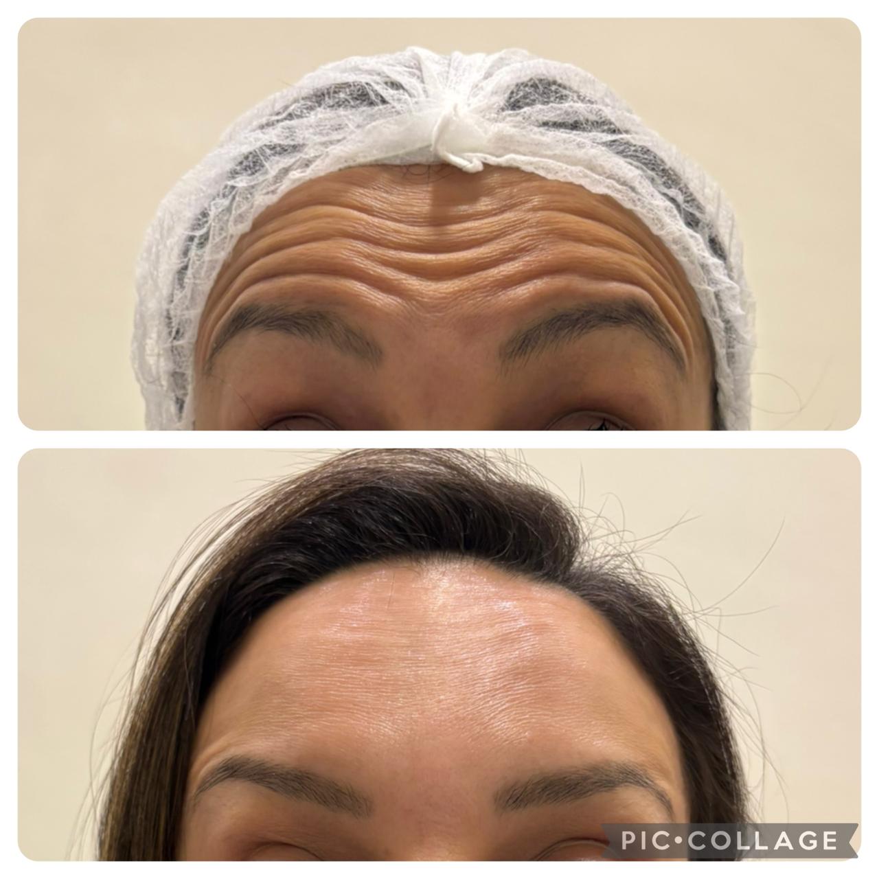 Antes e depois — toxina botulínica, testa
